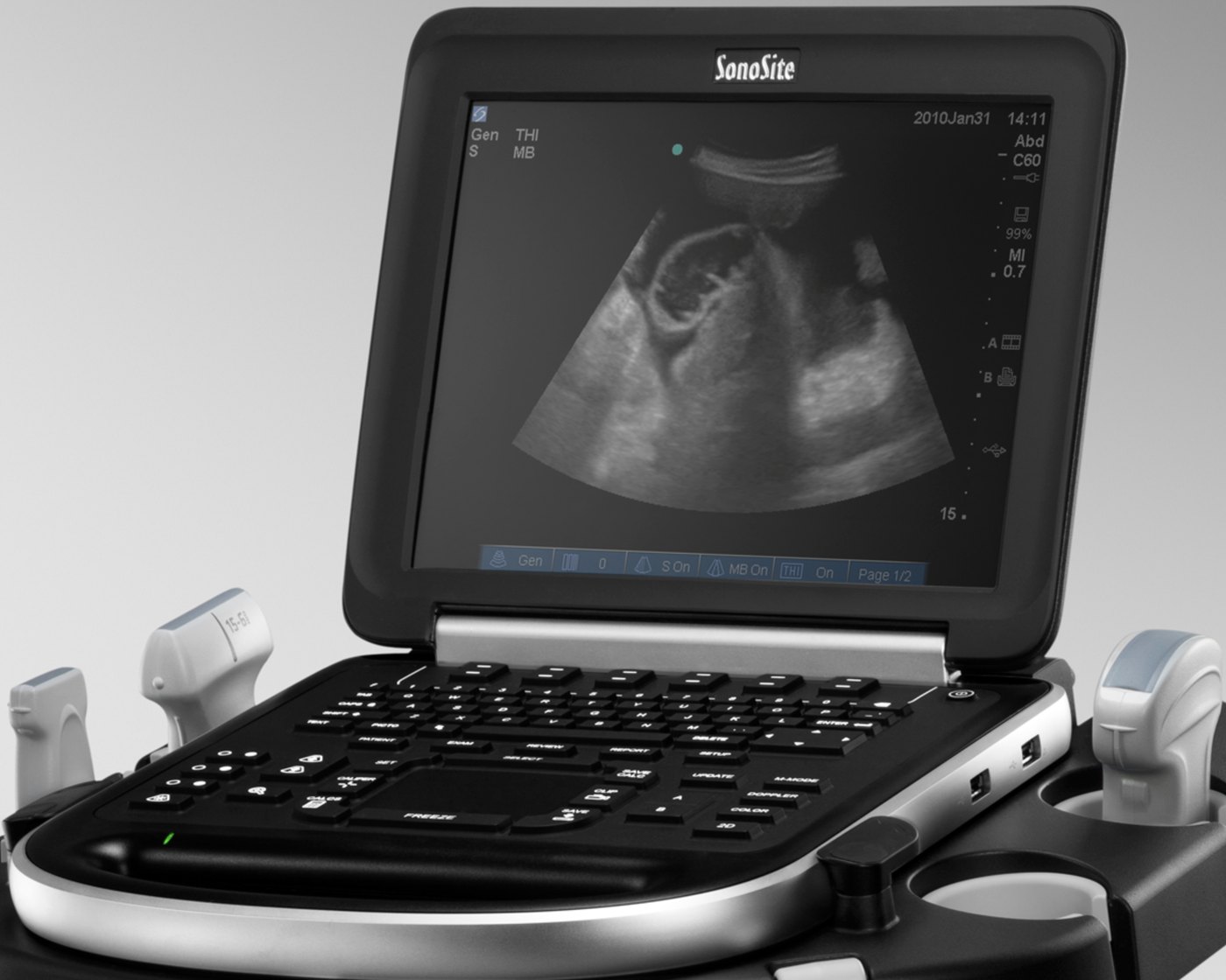 The SonoSite Edge open, showing an abdominal scan on screen and the backlit keypad.